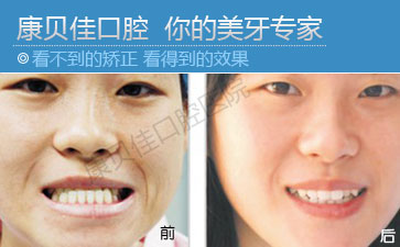 牙齿不齐如何矫正