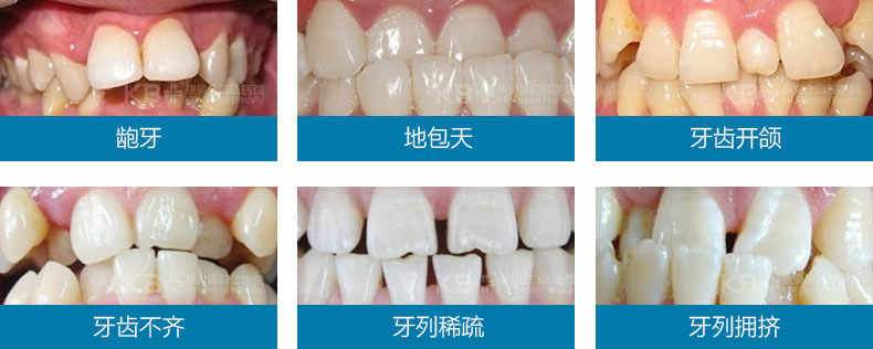 牙齿矫正